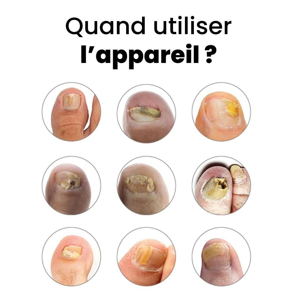 Orthovital - Appareil Anti-Mycose des Ongles