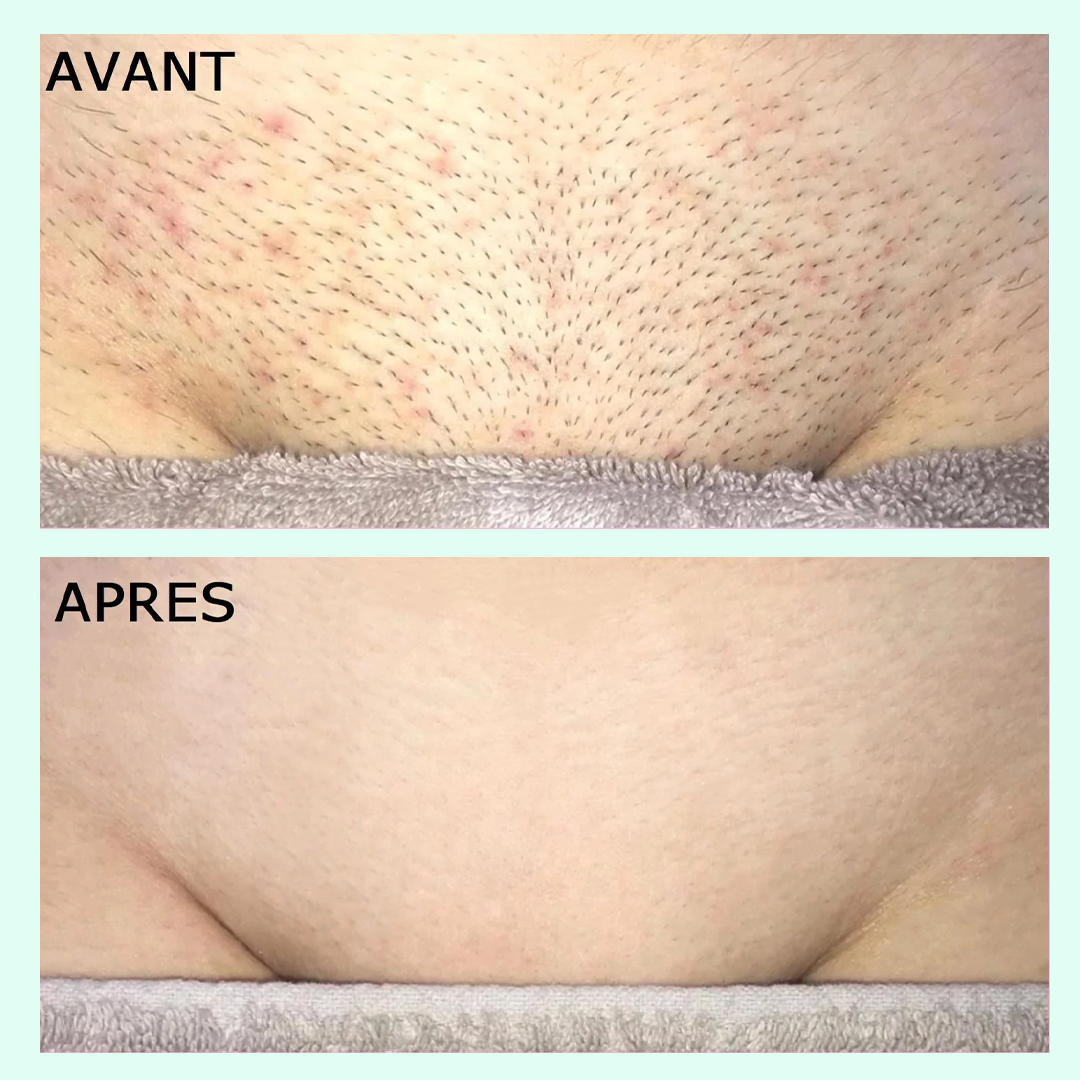 ÉPILATEUR LASER PEAU PARFAITE - NYZARA™