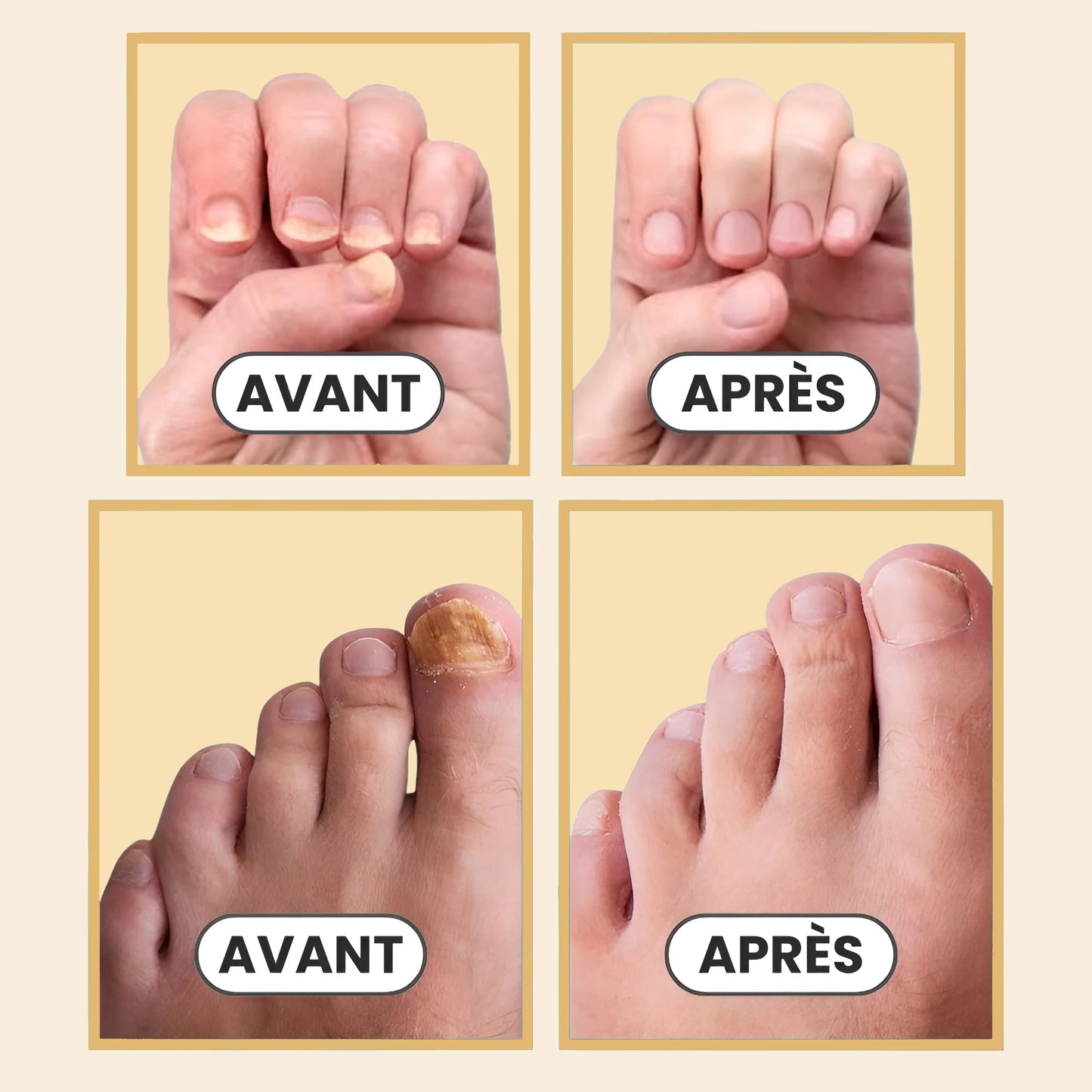 Orthovital - Appareil Anti-Mycose des Ongles