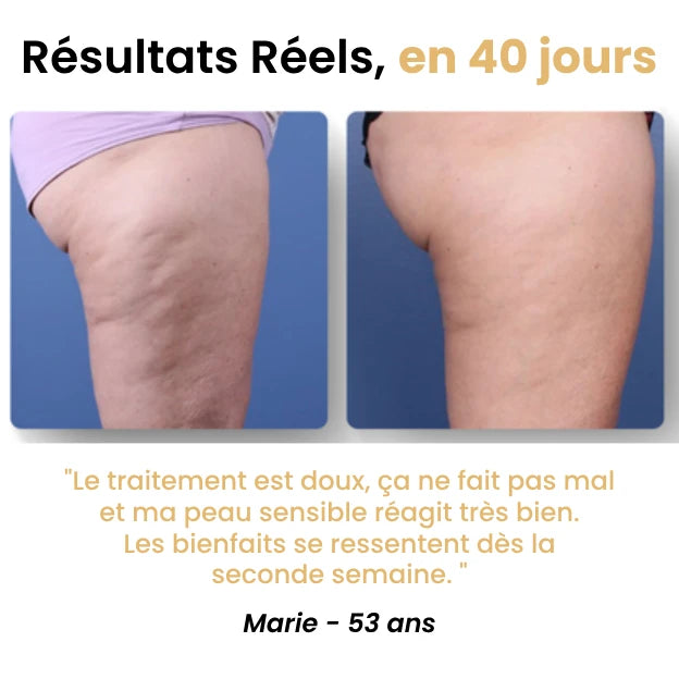Masseur Anti-Cellulite - Novaya™